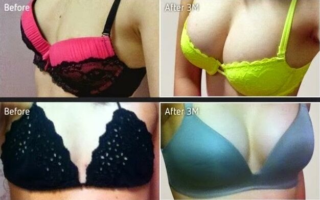 resulta sa plastic breast augmentation